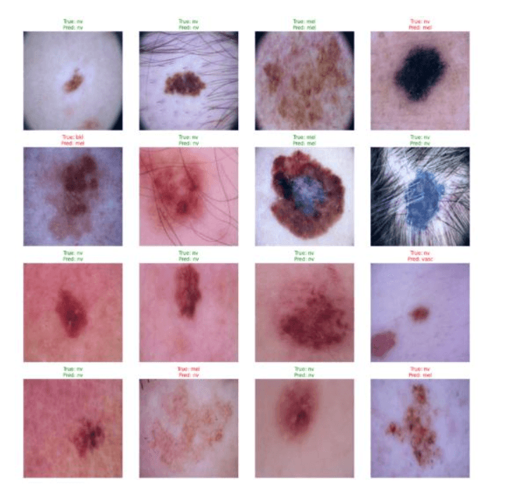 Self-Supervised Ensemble Learning for Skin Lesion Classification (HAM10000)